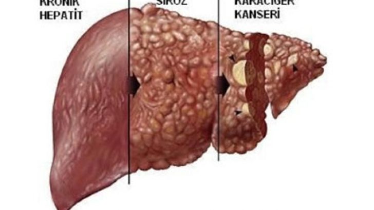 Karaciğer Yağlanması Nasıl Tedavi Edilir?