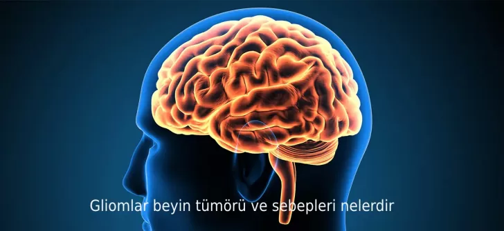 Gliomlar beyin tümörü ve sebepleri nelerdir